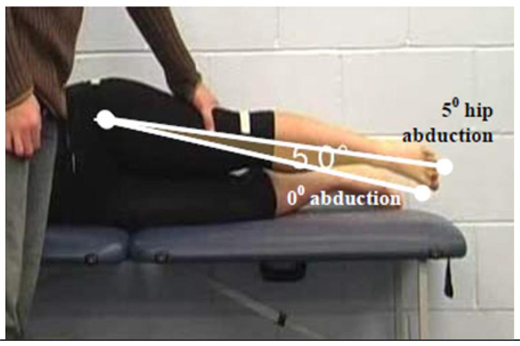 Primary Criterion #3 Hip Abduction loss of 3 muscle grade points (muscle grade of two). The figure shows manual resistance being applied at 5 hip abduction.