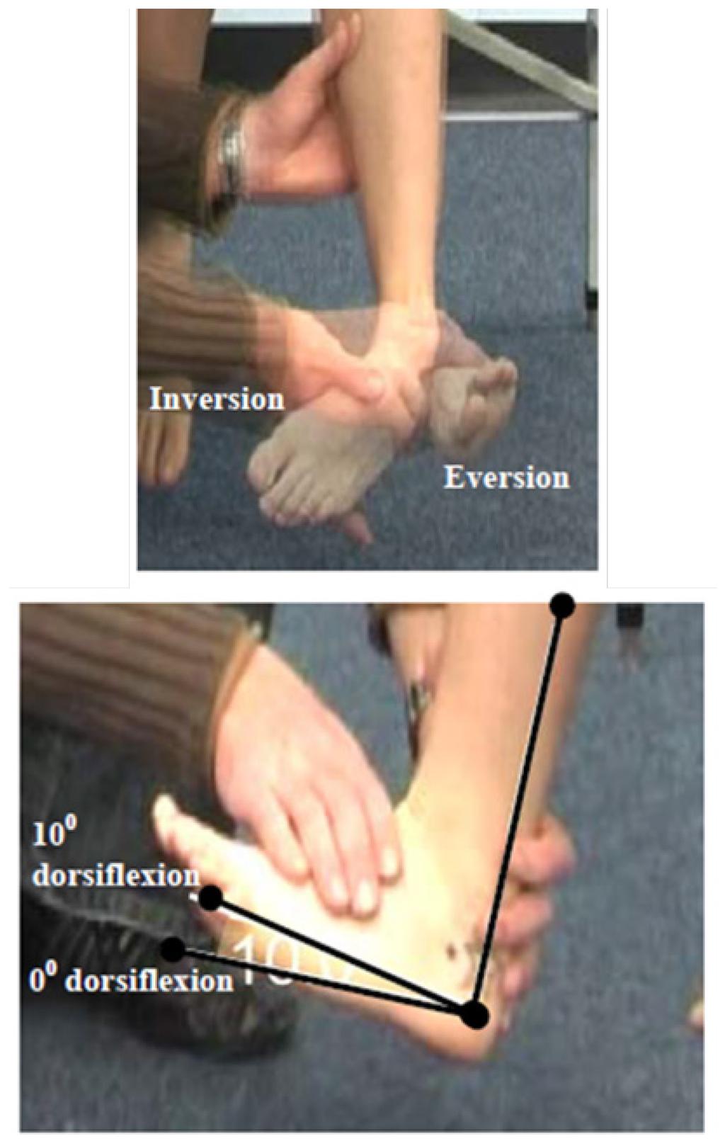 Primary Criterion #7 At least two of the following three muscle actions must have a loss of 3 points each: Ankle Dorsiflexion, Ankle Eversion, and Ankle Inversion.