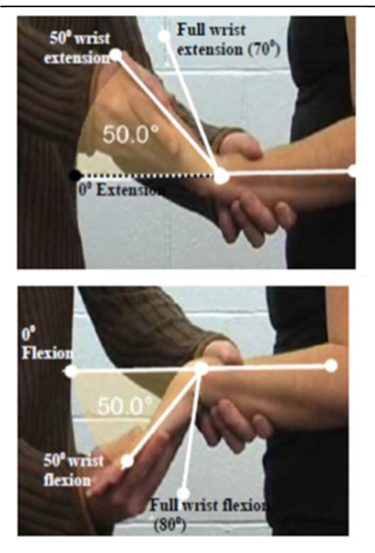 Criterion #4 Elbow extension deficit of 45 or ankylosis in any position*. The dashed lines in the figure are full elbow flexion (150 ) and full extension (0 ).