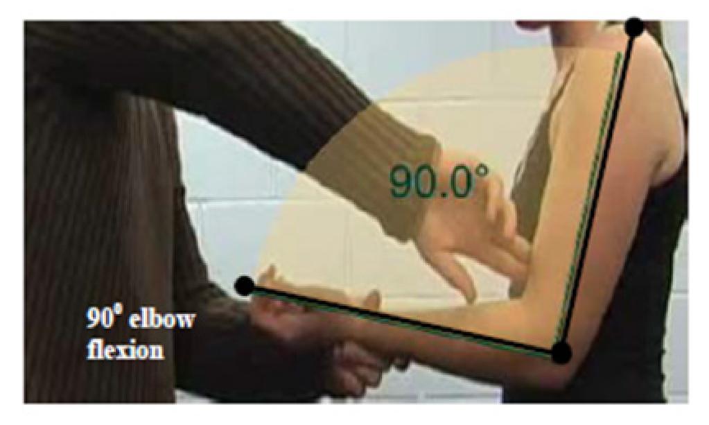 Criterion #5 Elbow flexion loss of 4 muscle grade points (i.e., muscle grade of 1).