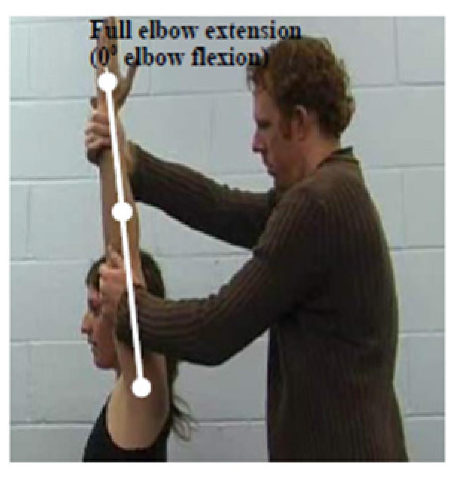 To meet this criterion there should be no active elbow flexion in this position. Criterion #6 Elbow extension loss of 3 muscle grade points (i.e., muscle grade of two).