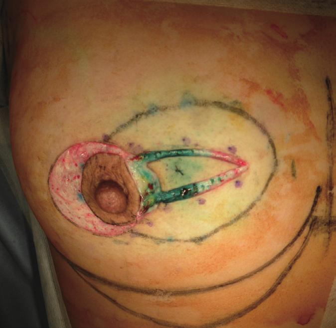 The skin incision line for the medial mammoplasty was also marked.