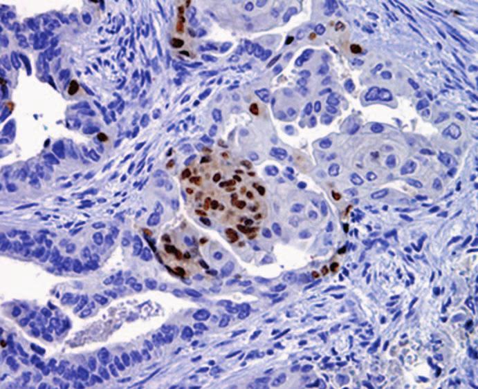 Infrequent CDX2 staining was seen in ovarian
