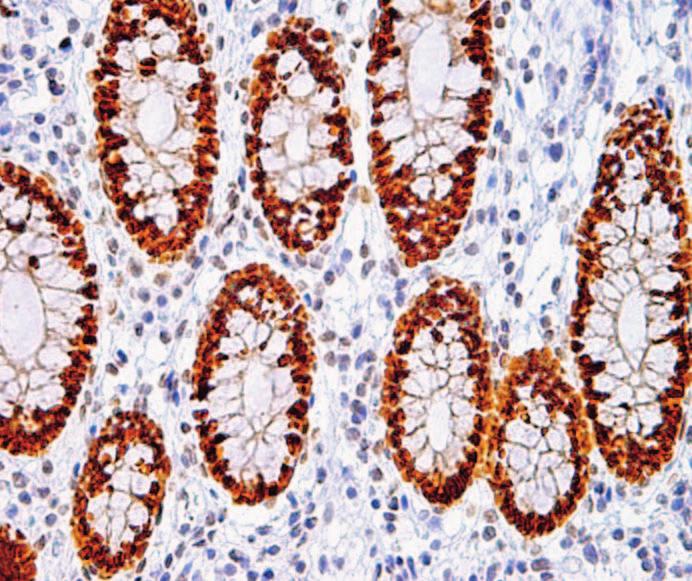 Results Immunohistochemical staining for both CDH17 and CDX2 was observed in all samples of benign colonic epithelium Image 1A and Image 1B, whereas epithelium from the esophagus, stomach, and