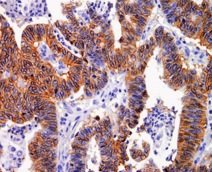 Panarelli et al / CDH17 in Gastrointestinal Carcinomas Table 1 Histopathologic Features and Immunohistochemical Staining Results in Gastrointestinal and Pancreatobiliary Carcinomas * Tumor Type CDH17