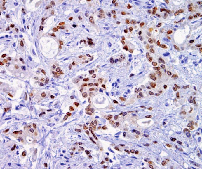 Image 3B and Image 3D. Eight (73%) low-grade cholangiocarcinomas showed CDH17 staining Image 3E and Image 3G, 4 of which were CDX2-positive Image 3F and Image 3H.
