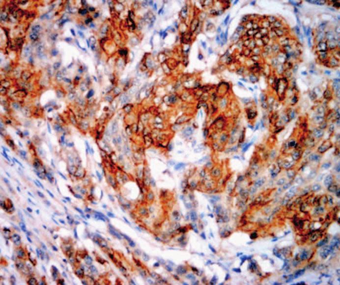 Focal CDH17 staining was present in 1 (2%) high-grade hepatocellular carcinoma, but all of these tumors were CDX2-negative Image 4D.