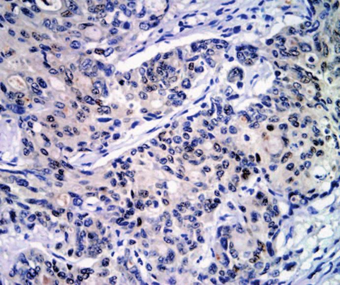 colonic adenocarcinoma. All 6 tumor pairs showed strong and diffuse CDH17 staining. In contrast, CDX2 showed diffuse strong staining in all 6 primary tumors, but only in 3 of the 6 metastases.