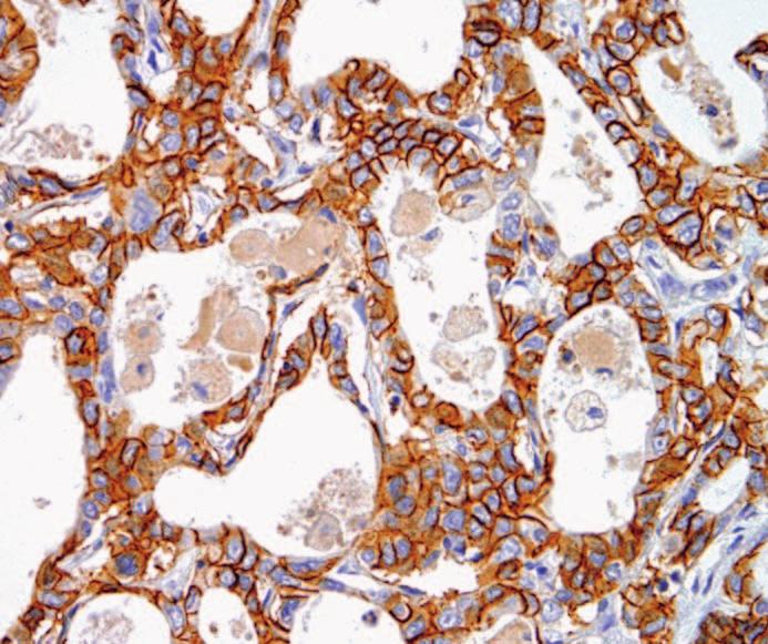 adenocarcinomas stained for both CDH17 (A) and CDX2