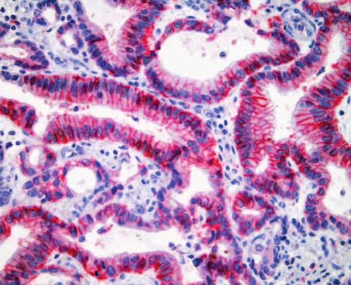 Dual staining performed on an esophageal adenocarcinoma