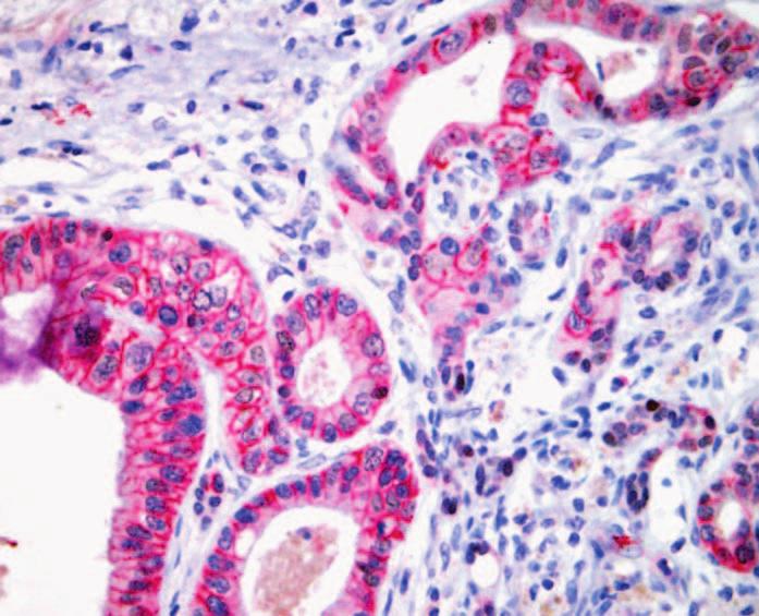 Some pancreatic ductal adenocarcinomas (C), and rare