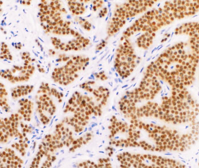staining in well-differentiated neuroendocrine