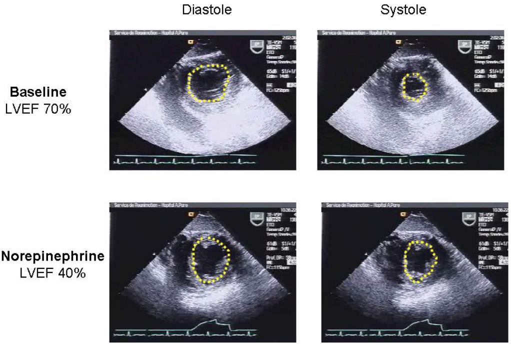 Diastole Systole Baseline LVEF 70%