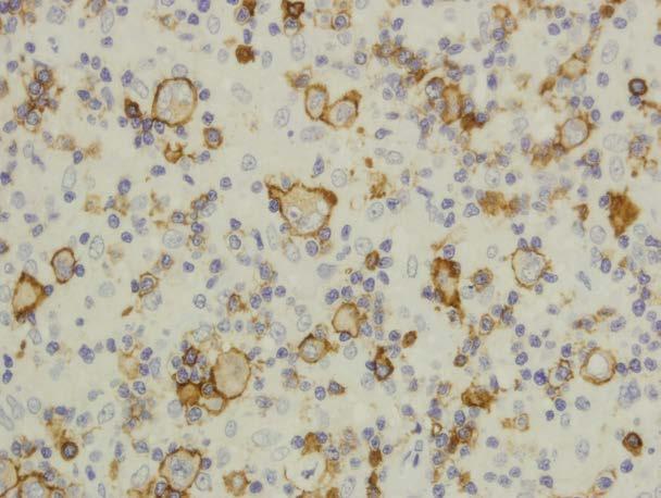 lymphocytes with CD20