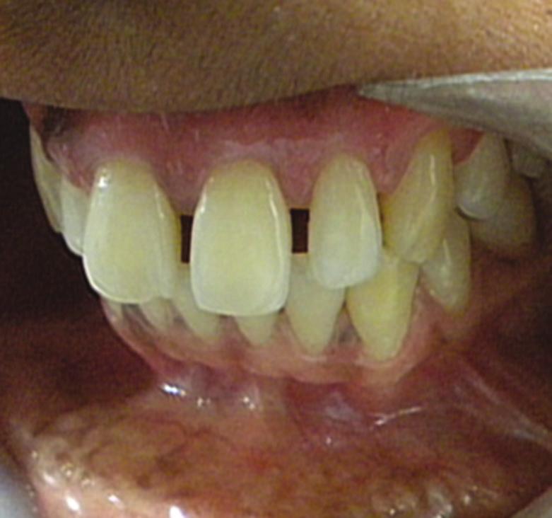 Patient who have not received any periodontal or antibiotic treatment 6 months prior to commencement of the study.