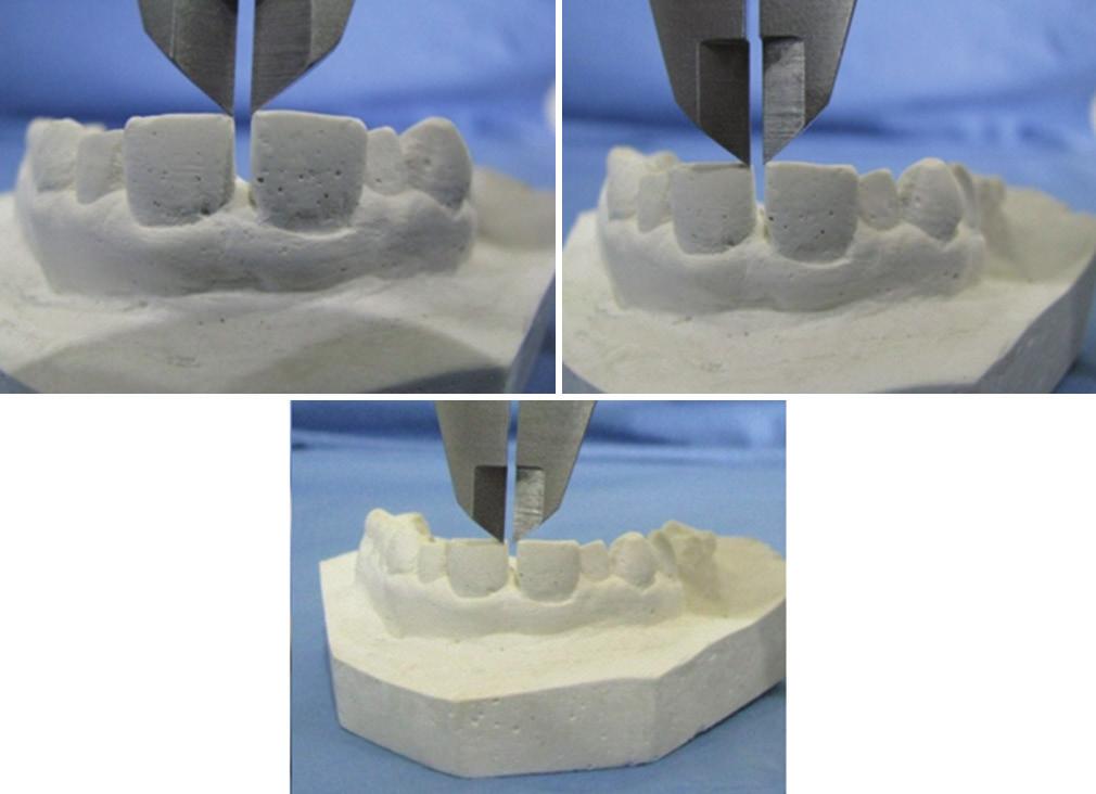 In this study, orthokal cast have been prepared for each subject for upper and lower jaws at baseline, 6 weeks and 4 months after surgical intervention (Figure 3).
