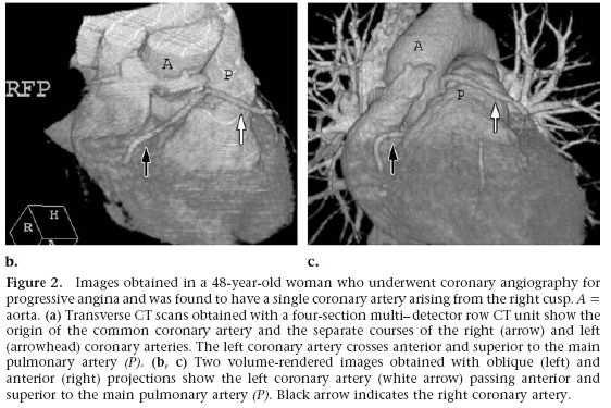 Single coronary, right cusp Cx Anterior to pulmonary