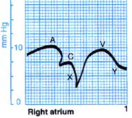 Right Atrial Waveform a wave - RA contraction elevated in RV failure c wave - tricuspid closure v wave - passive filling of RA during ventricular systole = T wave on
