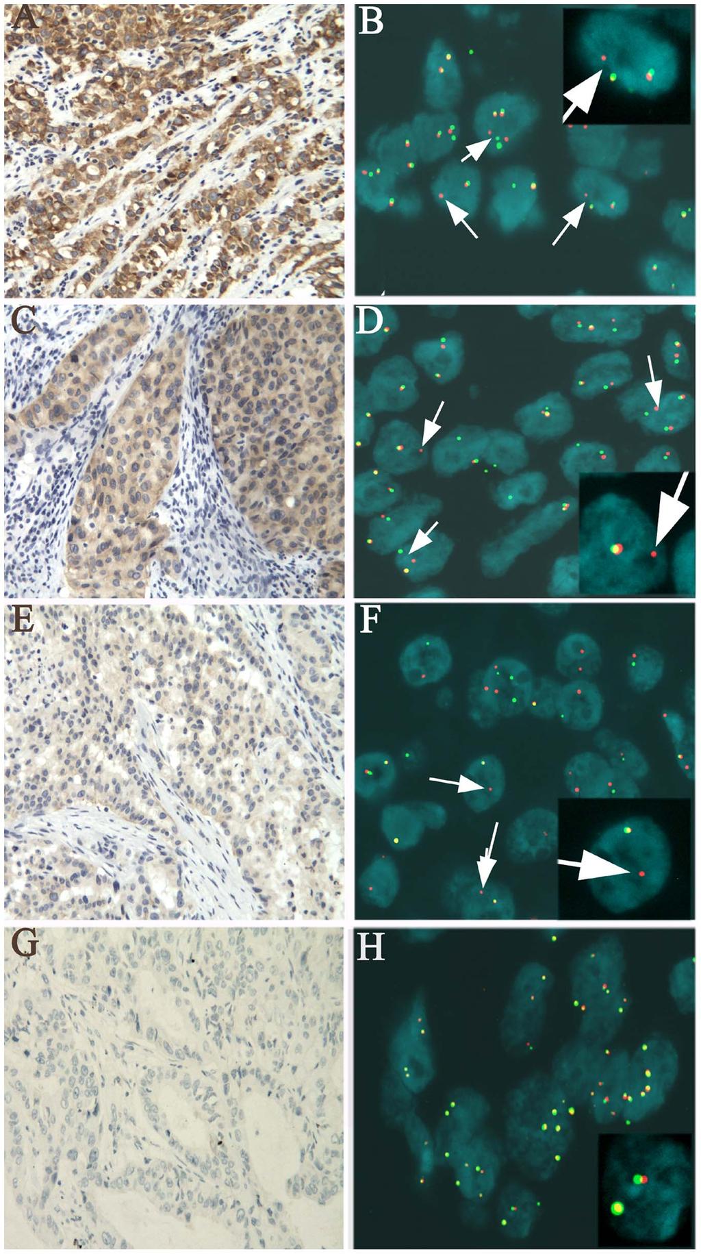 Figure 2. Histological features of ALK-rearranged lung adenocarcinomas. They showed solid signet-ring cell pattern (A), a cribriform structure (B.D), and abundant extracellular mucus (C). doi:10.