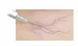 Sclerotherapy This technique involves injecting the problem vein with a chemical. This causes the blood vessel to close up and dissolve. Sclerotherapy is the main treatment option for spider veins.