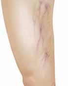 When Vein Problems Develop Most vein problems start when veins widen and stretch (dilate). When this happens, valves inside the veins can t close properly.