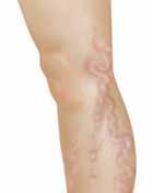 Clusters of spider veins can even look like a bruise. These veins are rarely harmful. However, the way they look can make you self-conscious.