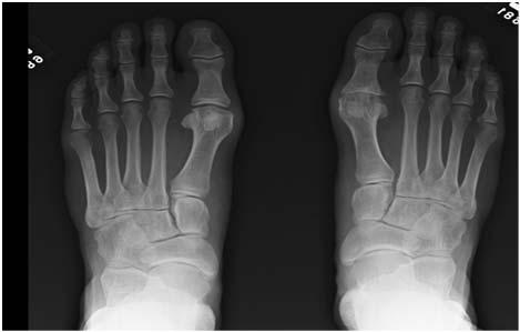 Ok for 5 years and Now Pain Complication: Progression of Arthritis and Symptoms Hallux Rigidus: Grade 3 Grade Motion Pain X-rays 1 20-50% loss 2 50-75% loss 3 75-100% loss Mild at extremes Moderate;