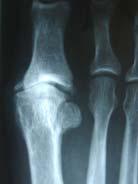 Systematic Review: 1 st Metatarsal Osteotomies for Hallux Rigidus Roukis (2010): Only 73% satisfaction rate 30.