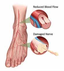 Diabetic Foot Ulcers Poor blood flow to LEs Diabetic Neuropathy