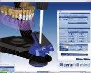 values programmed into the custom incisal guidance table.