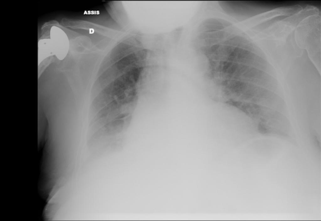 Fig. 4: Chest radiography: ARDS
