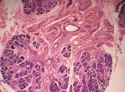 Figure 6 Figure 8 Figure 3: H&E section (10x) shows salivary gland tissue wi interspersed, ickened nerve bundles in plexiform neurofibroma of submandibular salivary gland Figure 5: Gross specimen of