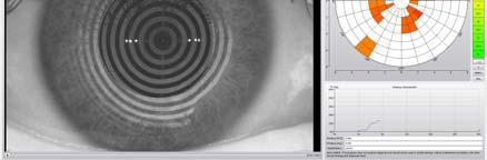 Tear Film Dynamics Lipid Layer Assessment 19 Oculus Keratograph 5M