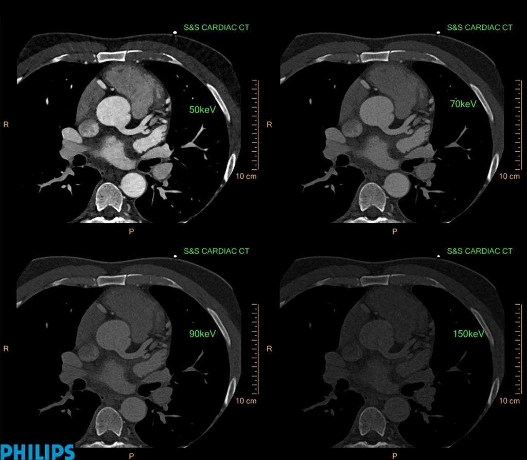 IQon Spectral CT: Step & Shoot Cardiac reconstructed at different energy