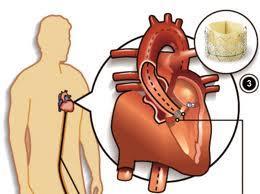 Structural Heart Interventions TAVI -