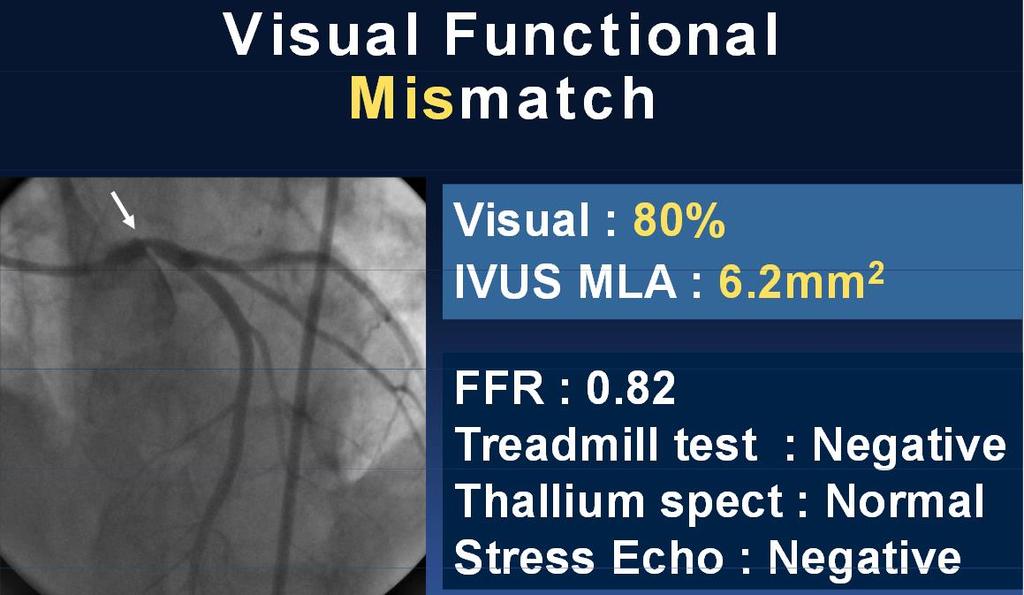 LM Disease: 5% of pts with