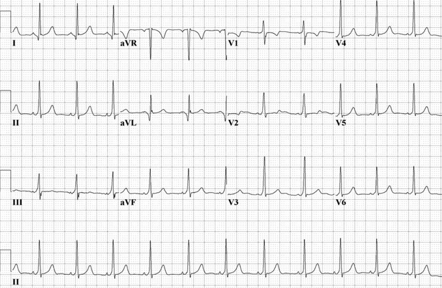 A 14-year-old girl with Wolff-Parkinson-White syndrome and recurrent paroxysmal palpitations due to atrioventricular reentry tachycardia had undergone two prior failed left lateral accessory pathway