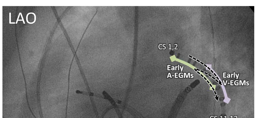 Figure 1. Intracardiac electrograms during sinus rhythm. Similarly early far field ventricular activation is seen on electrograms at CS 5 6, 7 8, 9 10 and ABLd.