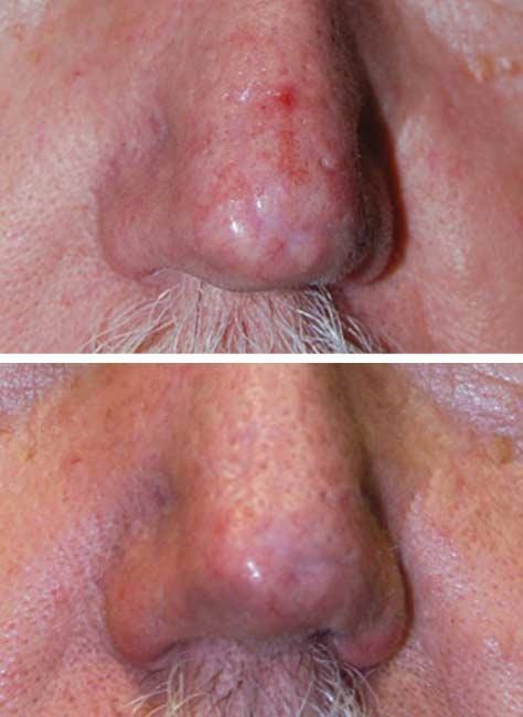 A A B B Figure 2. A 62-year-old man with Fitzpatrick skin type II, who had a nasal scar after a Mohs reconstruction using local flaps. A, Before treatment.