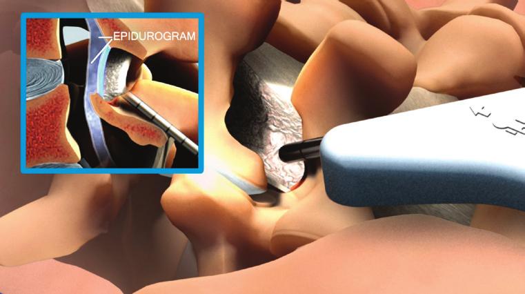 The unique, patented mild Tissue Sculpter enables the physician to gently debulk this ligament through a 5.