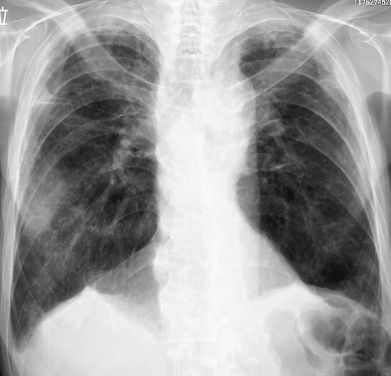 Table1. LaboratoryFindingsonAdmision Figure1. ChestX-rayfilmsshowinginfiltrativeshadowsin therightmiddlelungfield. opacity (GGO) in the right lower lobe and right pleural effusion (Fig. 2).