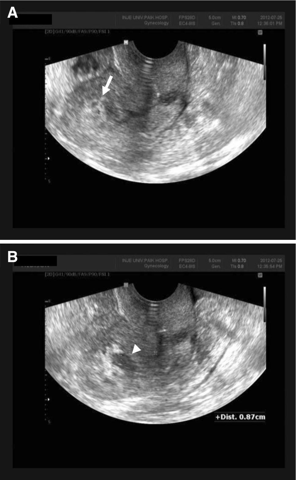 Byun et al. The Journal of Obstetrics and Gynecology of India (July August 2015) 65(4):273 277 diagnosis of an endometrial polyp [8, 9] or sometimes leiomyoma [10].