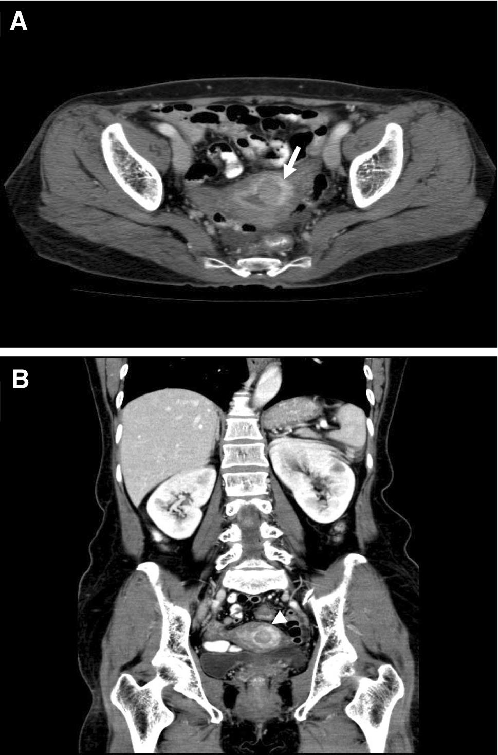 Case Report A 56-year-old woman, gravida 4, para 2, was admitted to our institute in August 2012 for management of abnormal vaginal bleeding and uterine malignancy tumor.