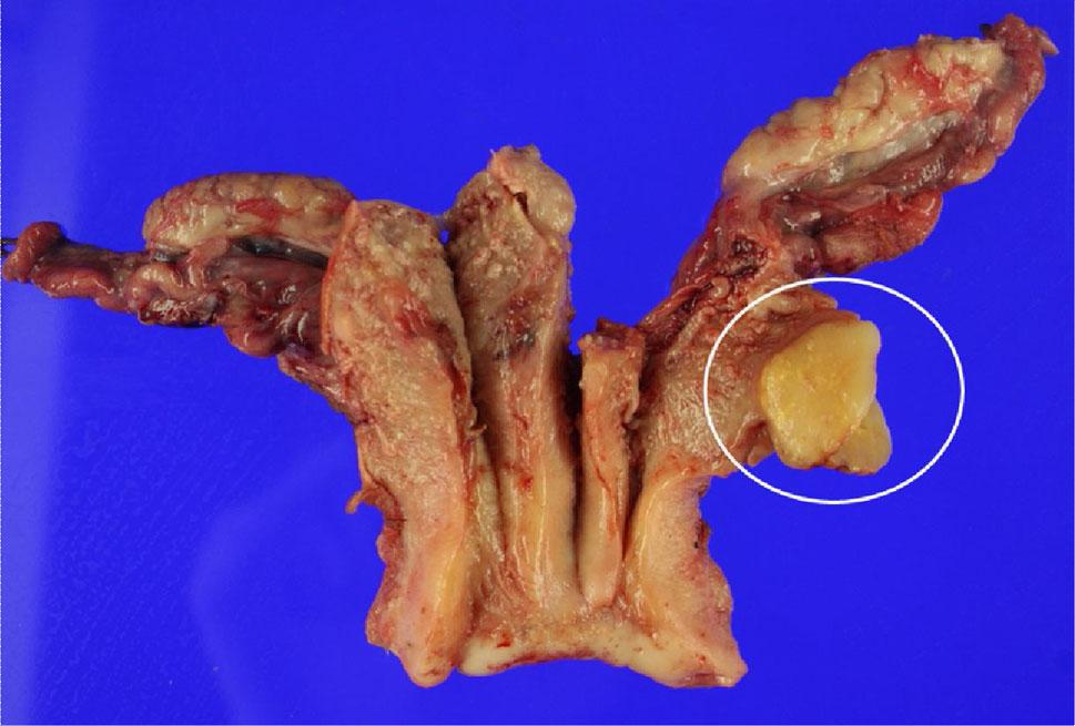 Pathology indicated malignant tumor with rhabdoid features, and the patient was Fig. 2 Computed tomography (CT) of the abdomen and pelvis. a Axial view of abdominal and pelvic CT.