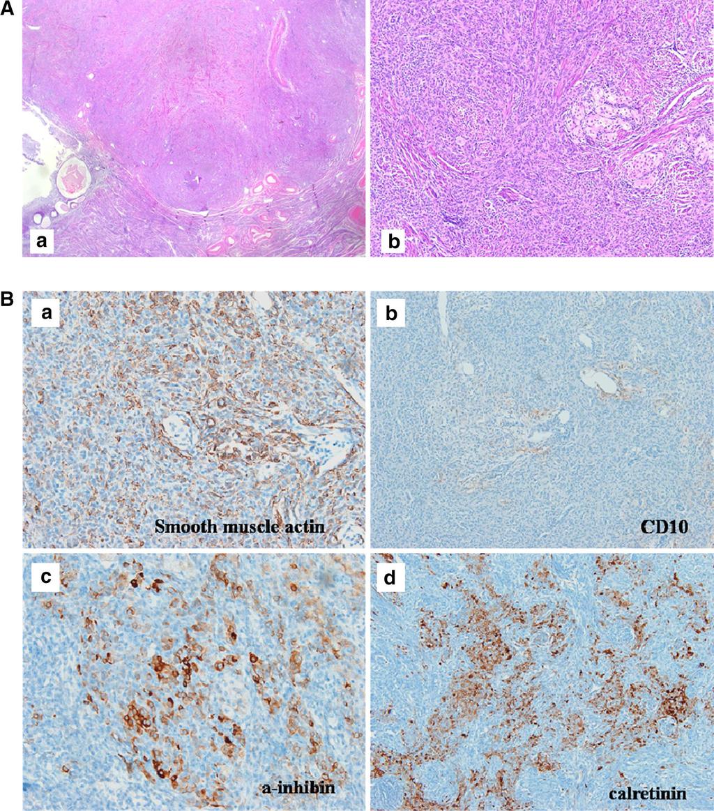 Fig. 4 a Microscopic view. The mass is located submucosally and is relatively well delineated. Compactly packed elongated or rounded tumor cells with scattered larger cell clusters are seen.