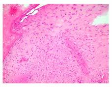 ossification No distinctive appearance Double Inactivation of NF1 in Pseudarthrosis