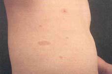 Diagnostic Criteria for NF1 NIH, 1987: Two of 7 Multiple café-au au-lait spots Crowe s s sign: intertriginous freckling pattern Lisch