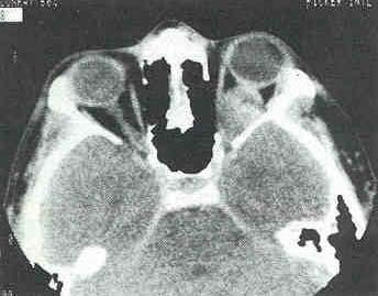 Optic Pathway Tumor
