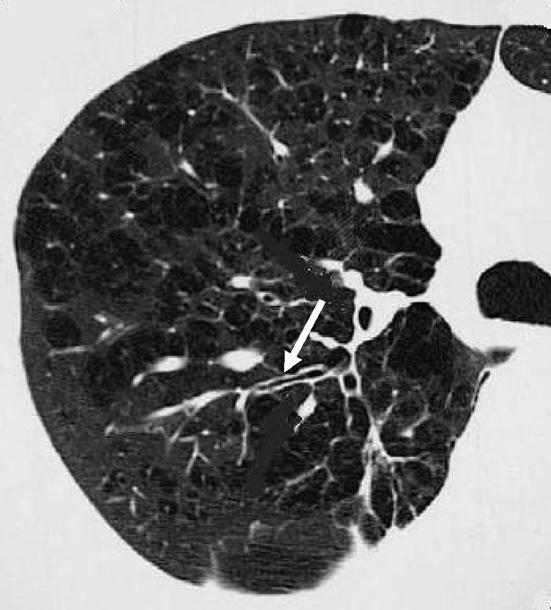 Role of the chest radiography, spirometry, and highresolution computed tomography 513 Case 1 Axial HRCT image in patient with centriacinar emphysema in the upper lobe shows multiple round lucent