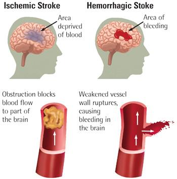 Occurs when blood flow to a portion of the brain is halted Causes & Risk Factors Certain types